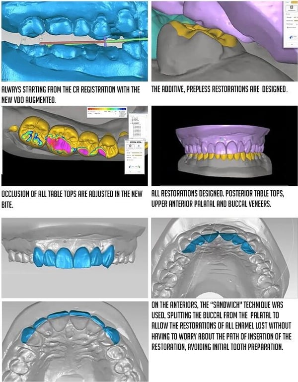 INDIRECT BONDED RESTORATIONS 1