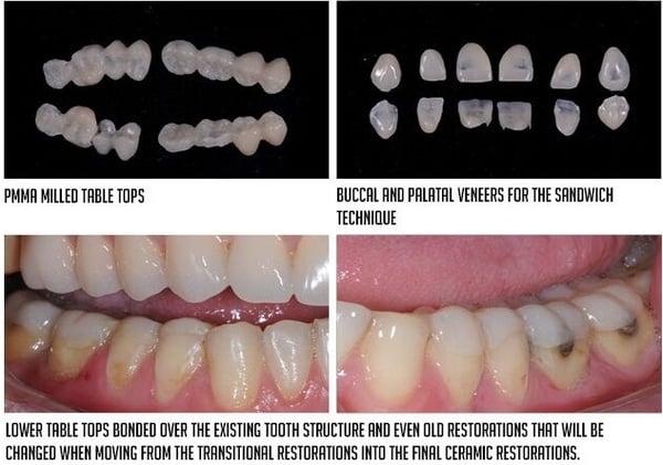 INDIRECT BONDED RESTORATIONS 2