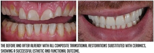 transitional restorations substituted with ceramics