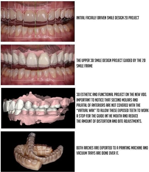 direct bonded restorations 1