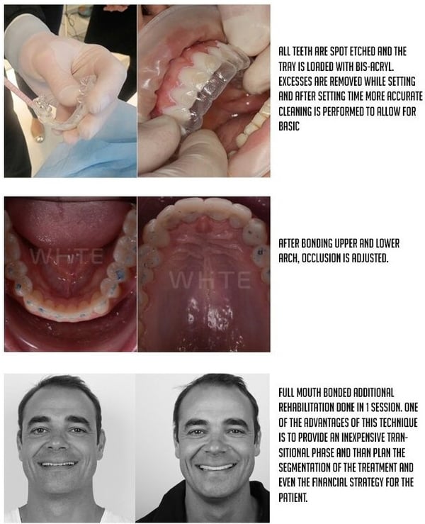 direct bonded restorations 2