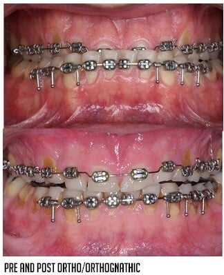 pre and post ortho/orthognathic