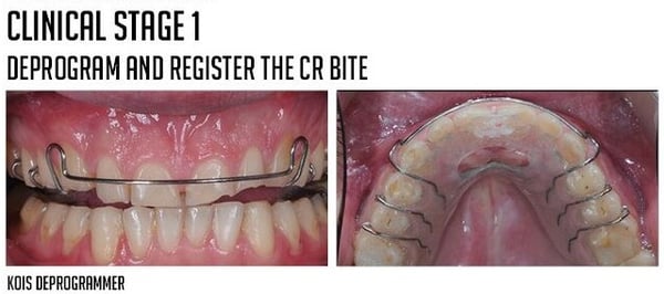 deprogram and register the cr bite