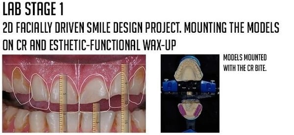 2D facially driven smile design project