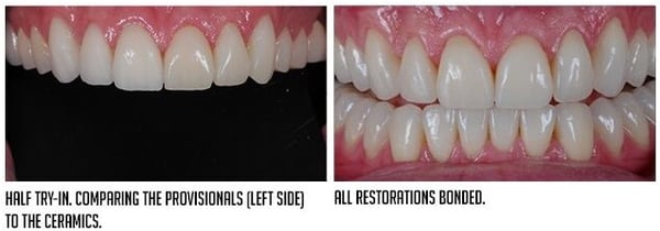 try-in, cementation and initial occlusal adjustment