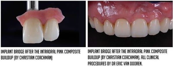 implant bridge