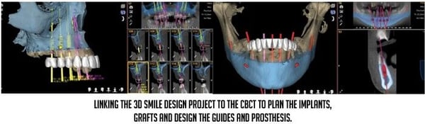 3D smile design project to CBCT