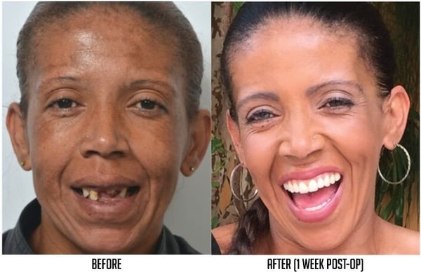 smile design implants before and after