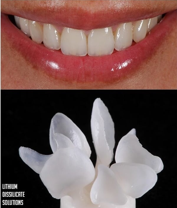 Perfect smile and lithium dissilicate solutions