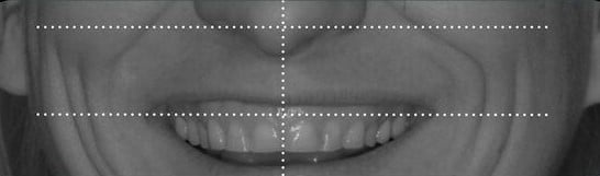 2D smile frame with guidelines