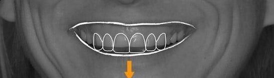 ideal tooth proportion