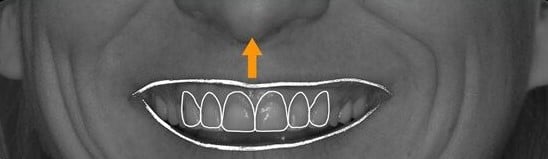 moving teeth upward