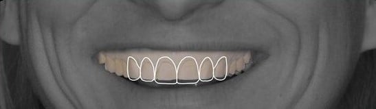 2D smile design to pre-op working model