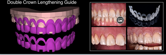 double crown lengthening Guide