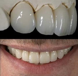 patient's teeth