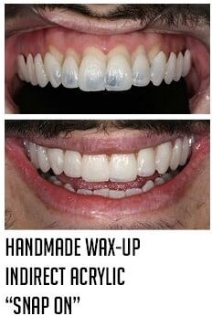 handmade wax-up indirect acrylic snap on