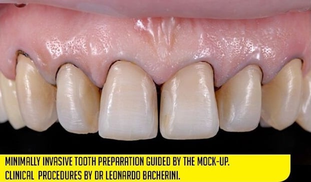 Tooth preparation by Dr Leonardo Bacherini