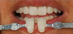 Desired tooth shade and final tooth prep