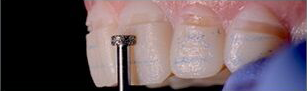 minimally invasive tooth prep by design