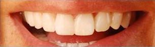 A tooth provisional 