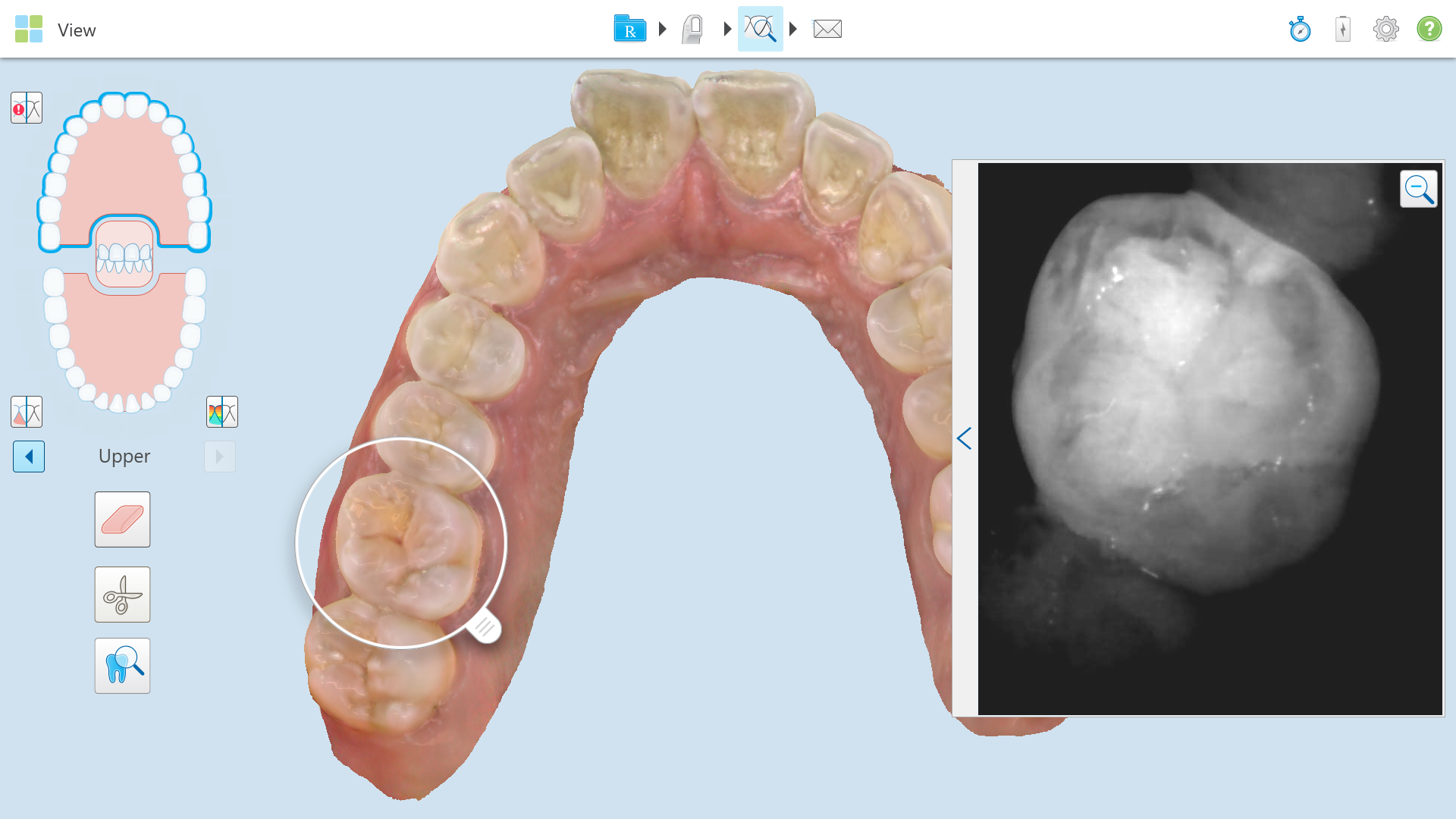 The on-screen view of a scan using the iTero Element 5D shows how NIRI Technology works.