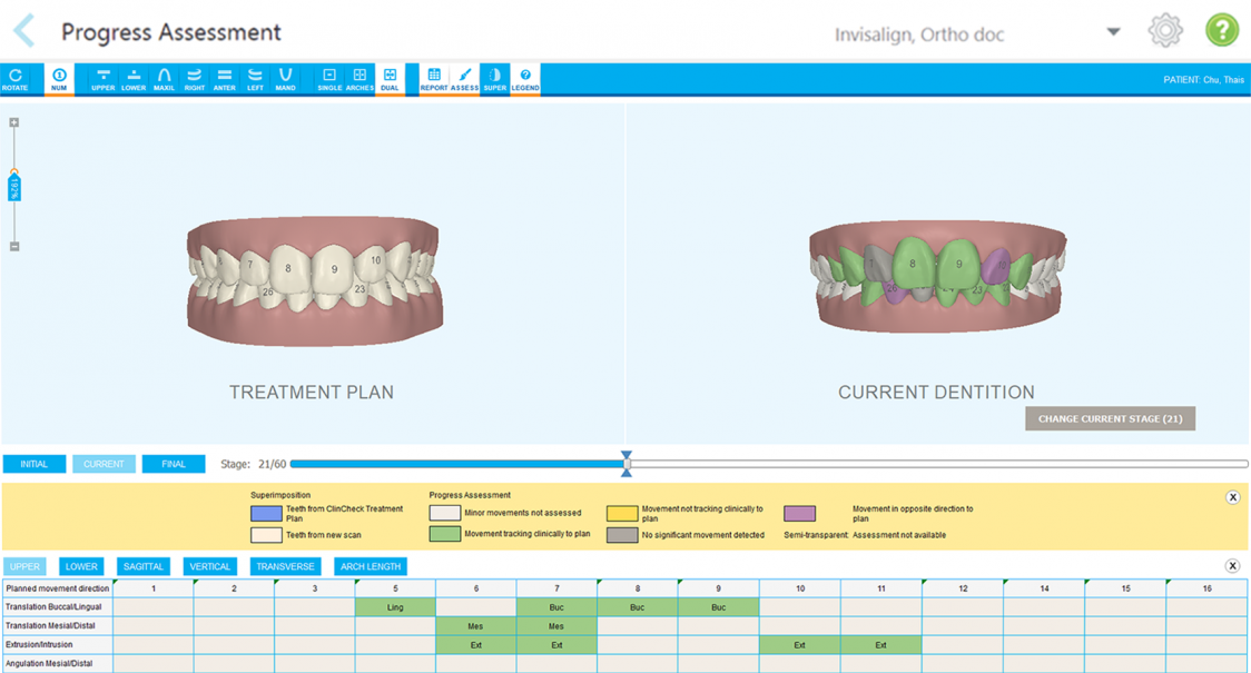 A view of the Progress Assessment tool of the iTero Element 5D intraoral scanner. 