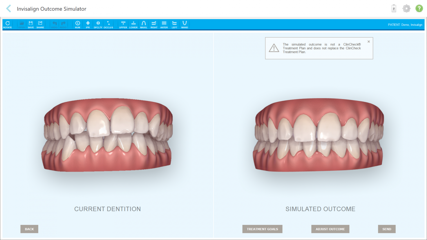 The on-screen view of a patient's teeth using the iTero Element 5D intraoral scanner shows how the Invisalign Outcome Simulator simulates the outcome of treatment.